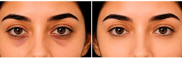Do EMS Eye Massagers Actually Work? The Science Behind Microcurrent Beauty