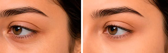 Visible under eye improvement after using red light therapy eye massager